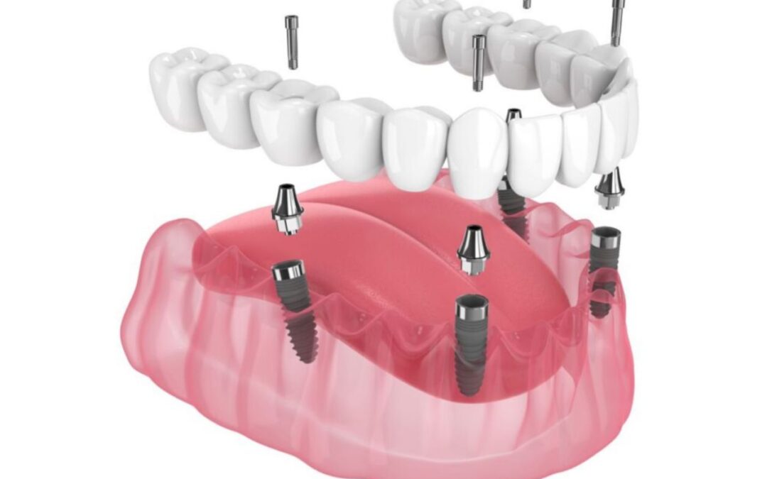 Are Penang Dental Implants Worth the Investment?