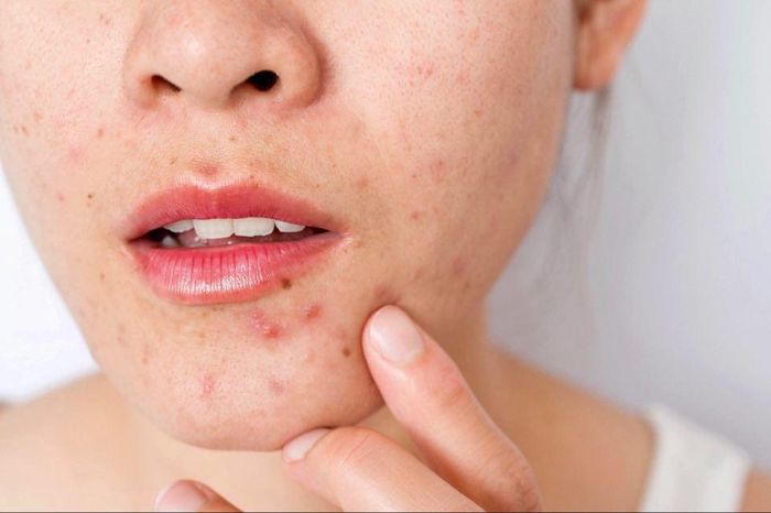 Acne Treatment Solutions for Stubborn and Severe Acne