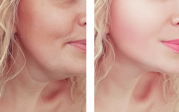 Contemporary Double Chin Removal in Abu Dhabi for Defined Features